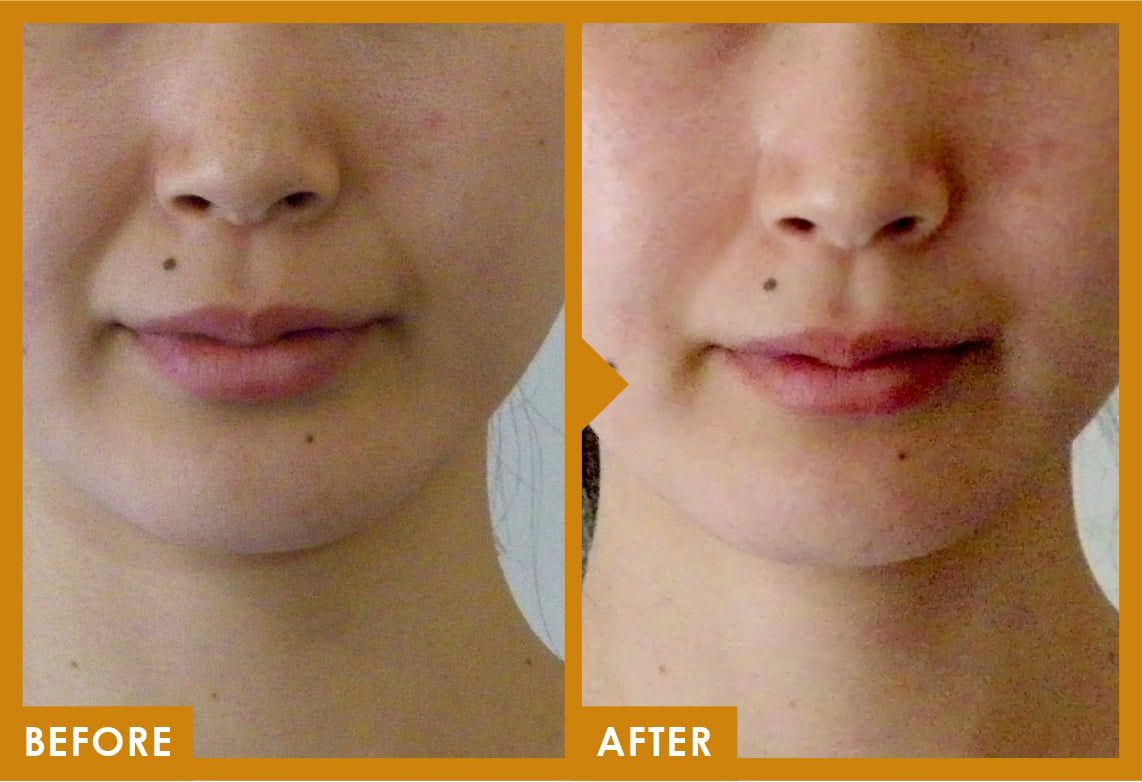 ケース写真[アンチエイジング(ほうれい線)]