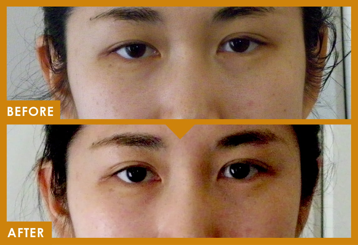 ケース写真[アンチエイジング(目元)]